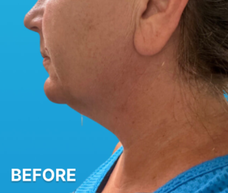 Double-Chin-Turkey-Neck-Rescue-Treatment (1)