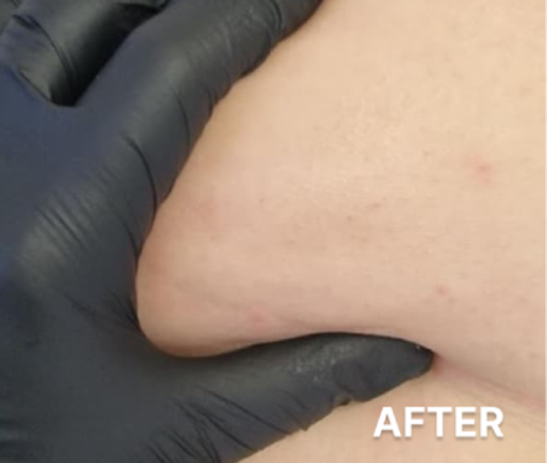 Double-Chin-Turkey-Neck-Rescue-Treatment (10)