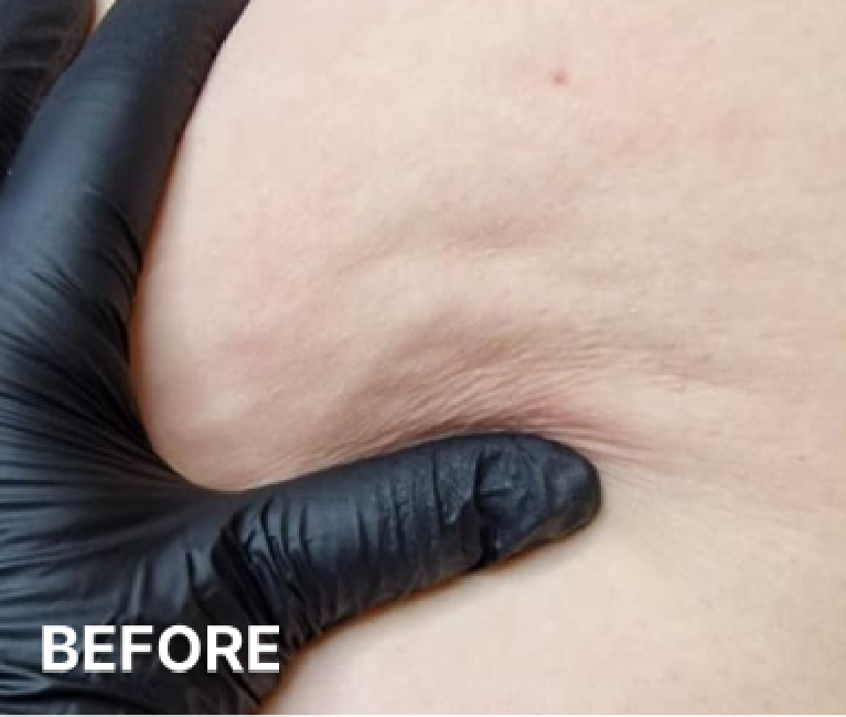 Double-Chin-Turkey-Neck-Rescue-Treatment (11)