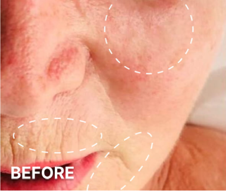 Double-Chin-Turkey-Neck-Rescue-Treatment (2)