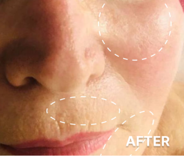 Double-Chin-Turkey-Neck-Rescue-Treatment (3)