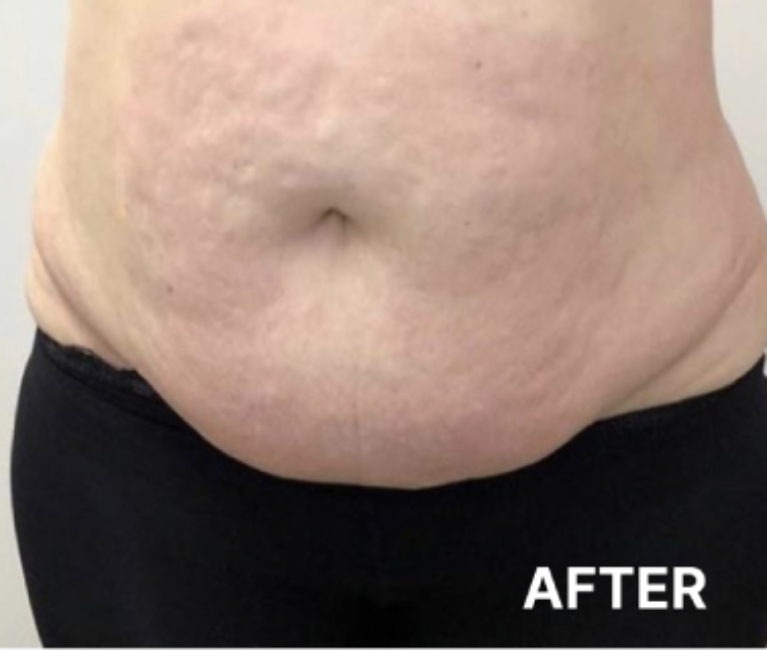 Double-Chin-Turkey-Neck-Rescue-Treatment (4)