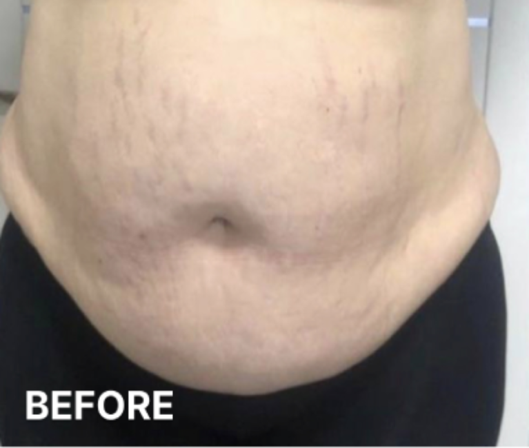 Double-Chin-Turkey-Neck-Rescue-Treatment (5)