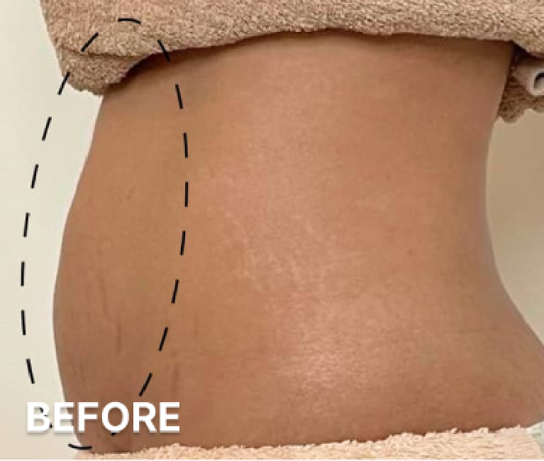 Double-Chin-Turkey-Neck-Rescue-Treatment (7)