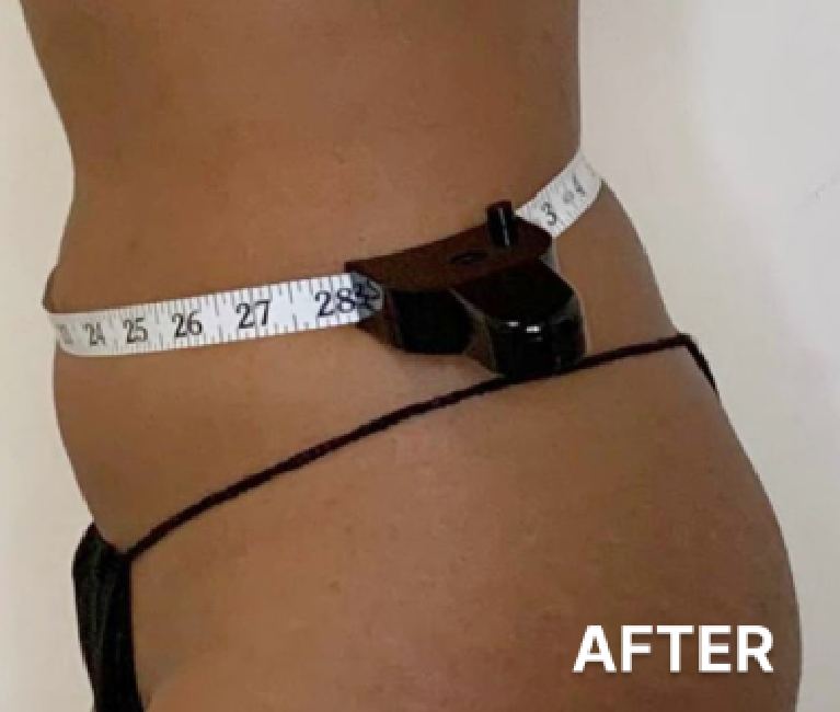 Double-Chin-Turkey-Neck-Rescue-Treatment (8)