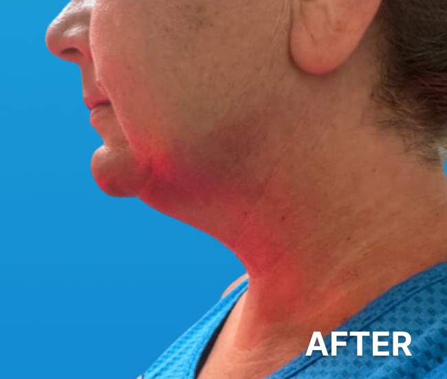 Double-Chin-Turkey-Neck-Rescue-Treatment